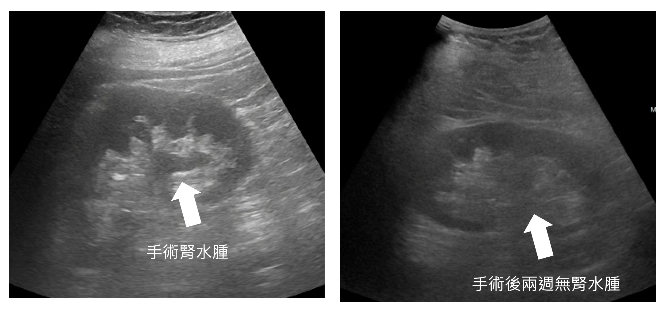 口腔黏膜修補術前術後比較
